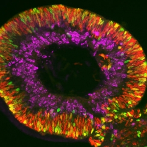 Les organoïdes rétiniens : un outil prometteur pour l'étude des maladies rares de la rétine